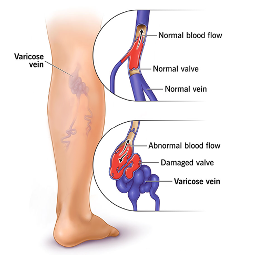 Comparison image: normal vs. damaged varicose veins, illustrating appearance and condition differences