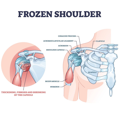 Frozen Shoulder Treatment