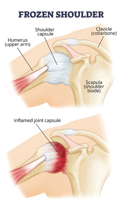 Frozen Shoulder Treatment