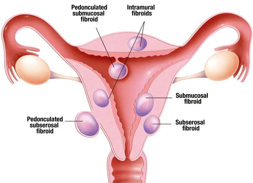 Fibroid Treatment