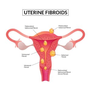 image showing types of uterine fibroids in the uterus with labeled locations