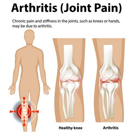 Osteoarthritis