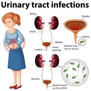 Hematuria illustration showing urinary tract infection affecting bladder and kidneys