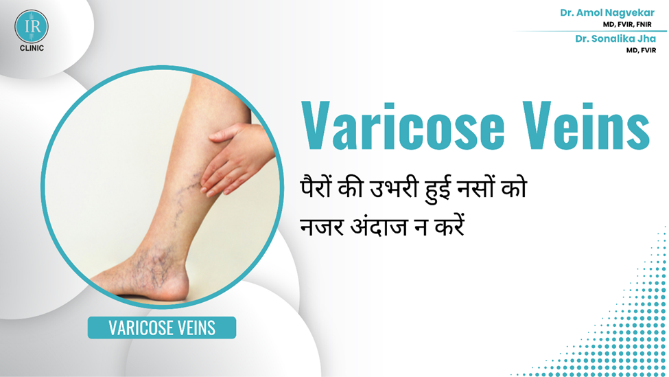 Varicose Veins (नसों का फूलना): पैरों की उभरी हुई नसों को न करें नजरअंदाज