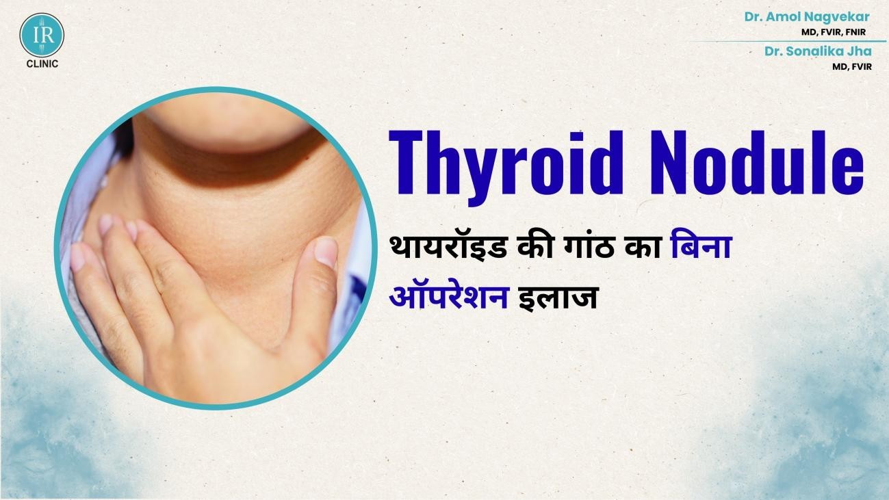 थायरॉइड की गांठ का बिना ऑपरेशन इलाज – क्या है Thyroid Ablation?
