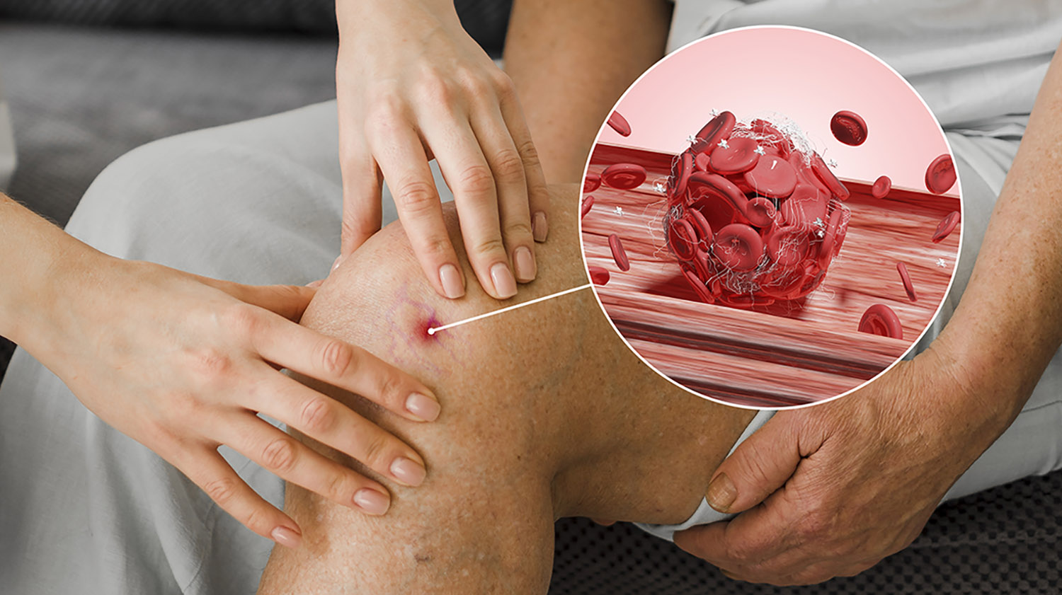 Vascular Malformation Treatment: इंटरवेंशनल रेडियोलॉजी कैसे मदद कर सकती है?