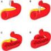 ICA-PSEUDOANEURYSM-POSTOP-TREATMENT