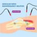 genicular-nerve-radifrequency-ablation