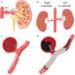 hematuria-from-pseudoaneurysm