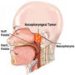 nasopharyngeal-angiofibroma