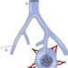 pelvic-avm-embolization