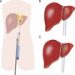 radio-frequency-ablation-for-hcc